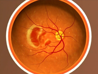 Signs You May Have Macular Degeneration