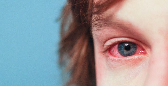 Allergy Management and Your Eyes
