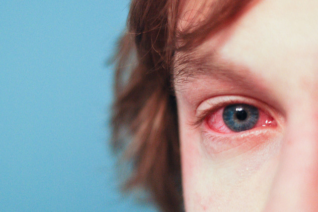 Red eyes? See an optometrist!
